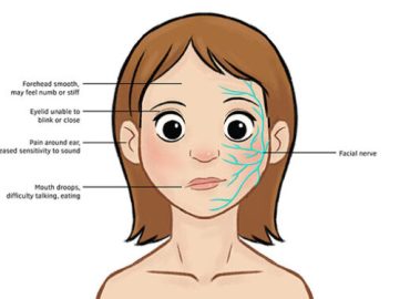 বেলস পালসি (What is Bell’s Palsy) ও কিছু কথা 13 bells pulsi 580x375 1